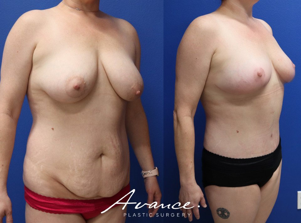 Before and After - Body