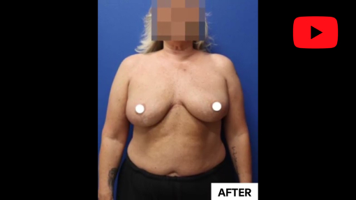 YouTube video titled Reno/Tahoe Breast Augmentation Revision Surgery | Dr. Erez Dayan