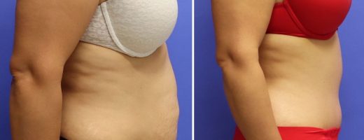 Before and After - Body