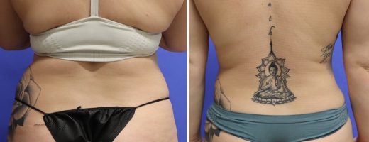 Before and After - 360 Liposucción