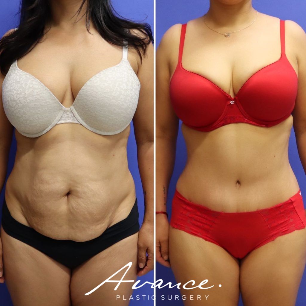 Before and After - Abdominoplasty