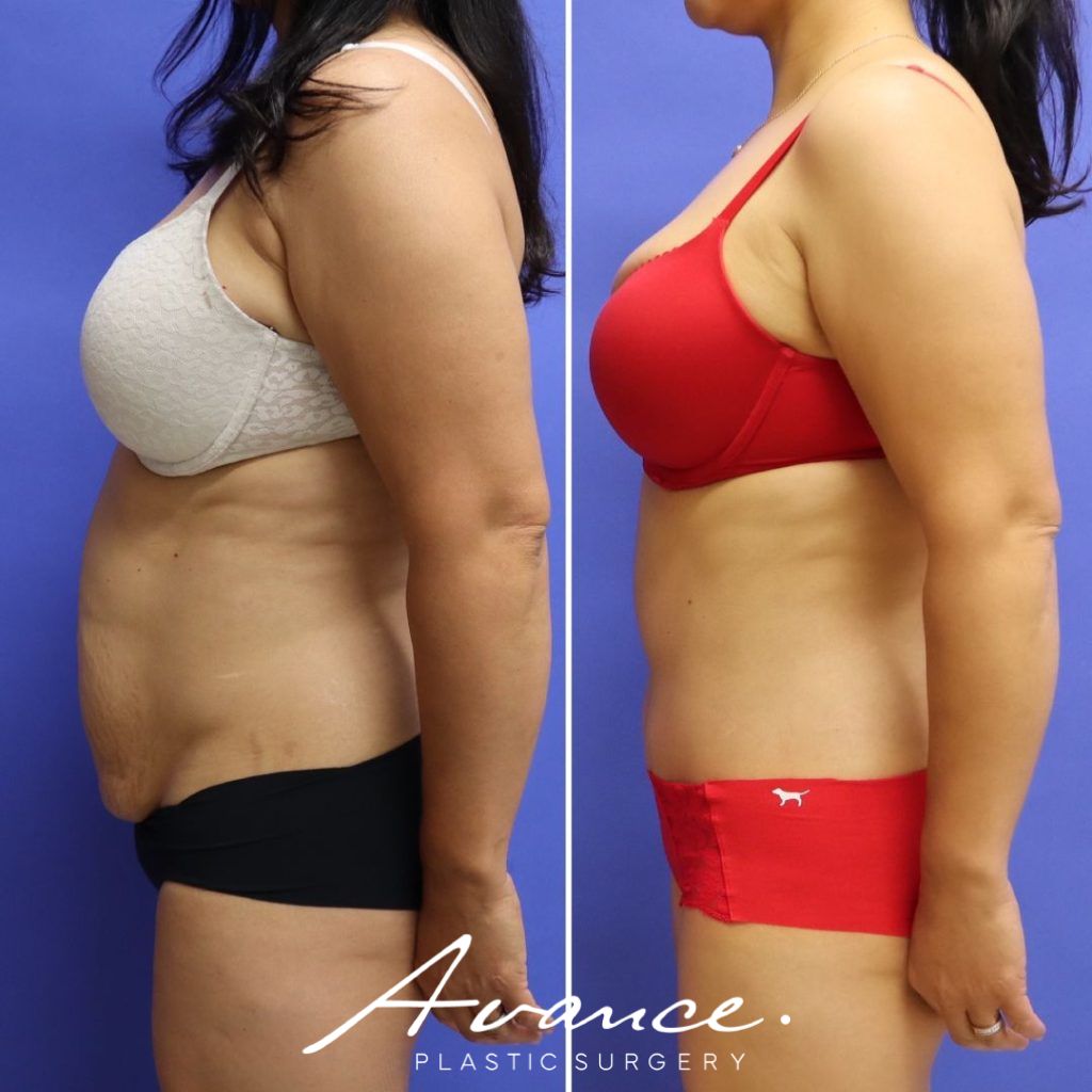 Before and After - Abdominoplasty
