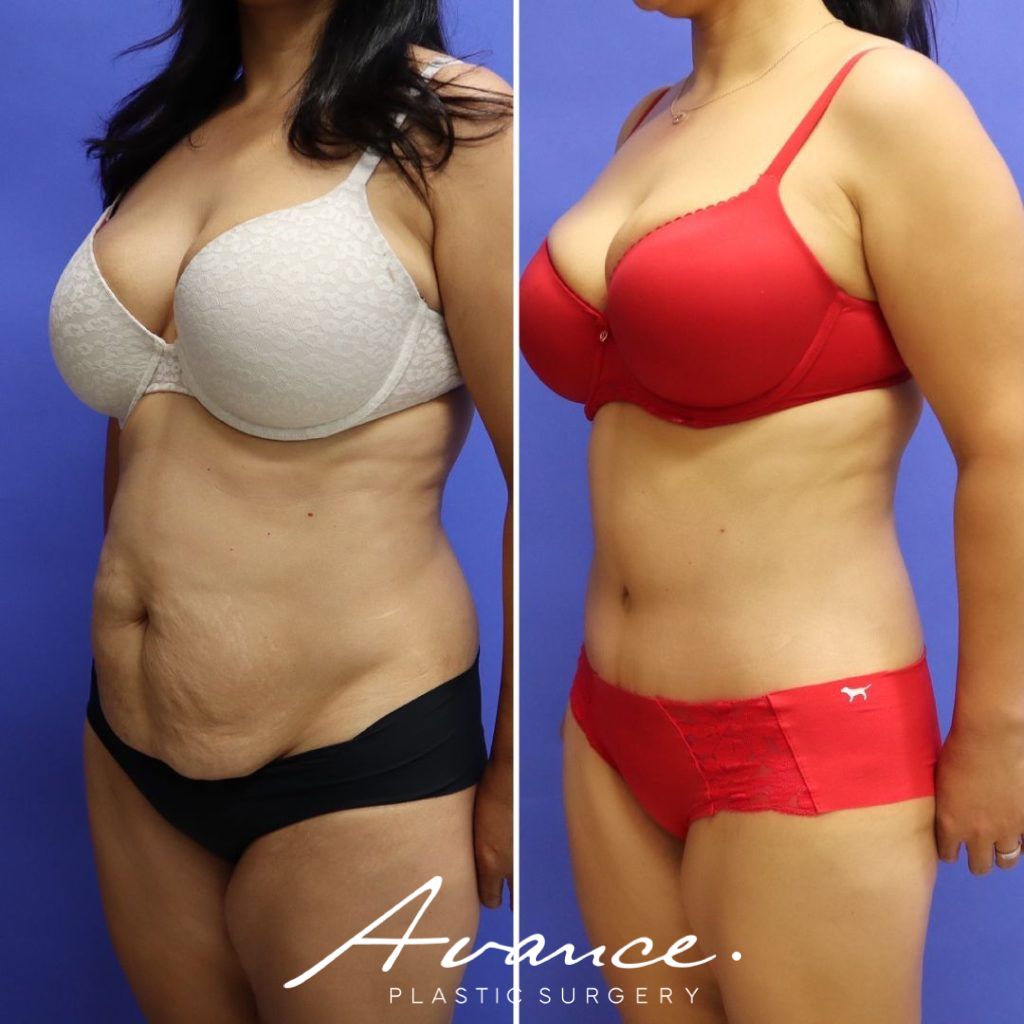 Before and After - Abdominoplasty