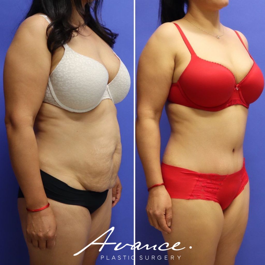 Before and After - Abdominoplasty
