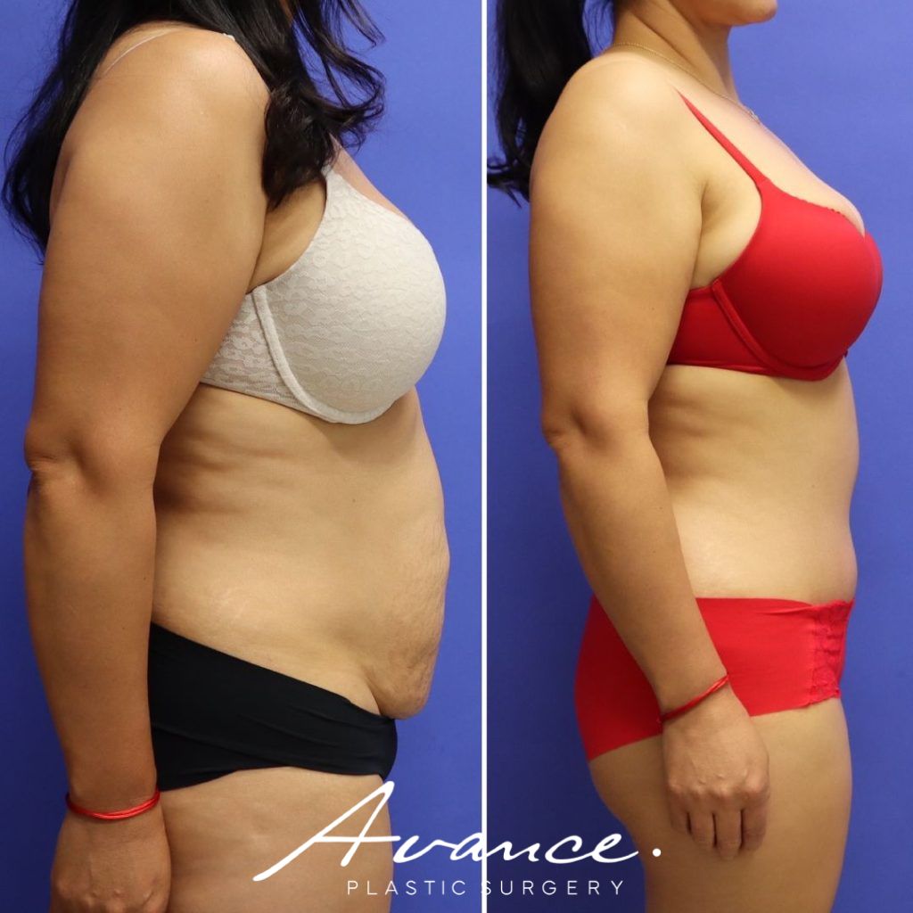 Before and After - Abdominoplasty