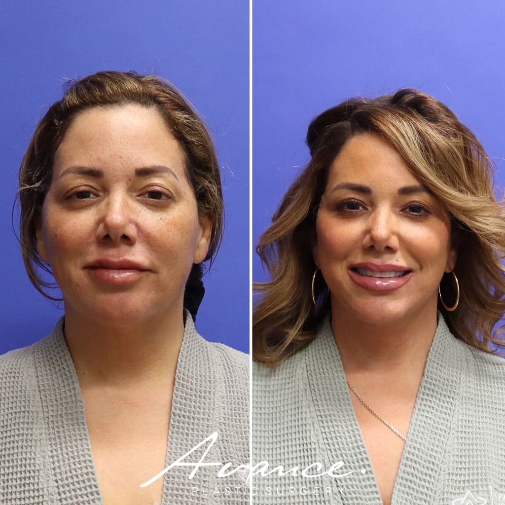 Before and After - Facelift/Necklift & Minifacelift/Necklift
