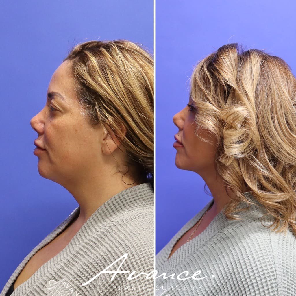 Before and After - Facelift/Necklift & Minifacelift/Necklift