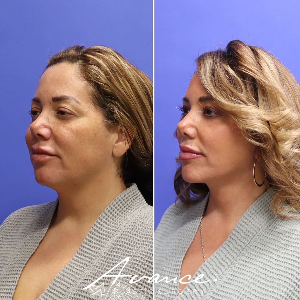 Before and After - Facelift/Necklift & Minifacelift/Necklift