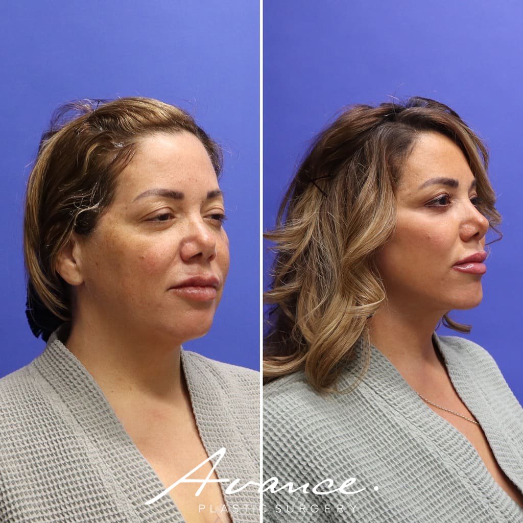 Before and After - Facelift/Necklift & Minifacelift/Necklift