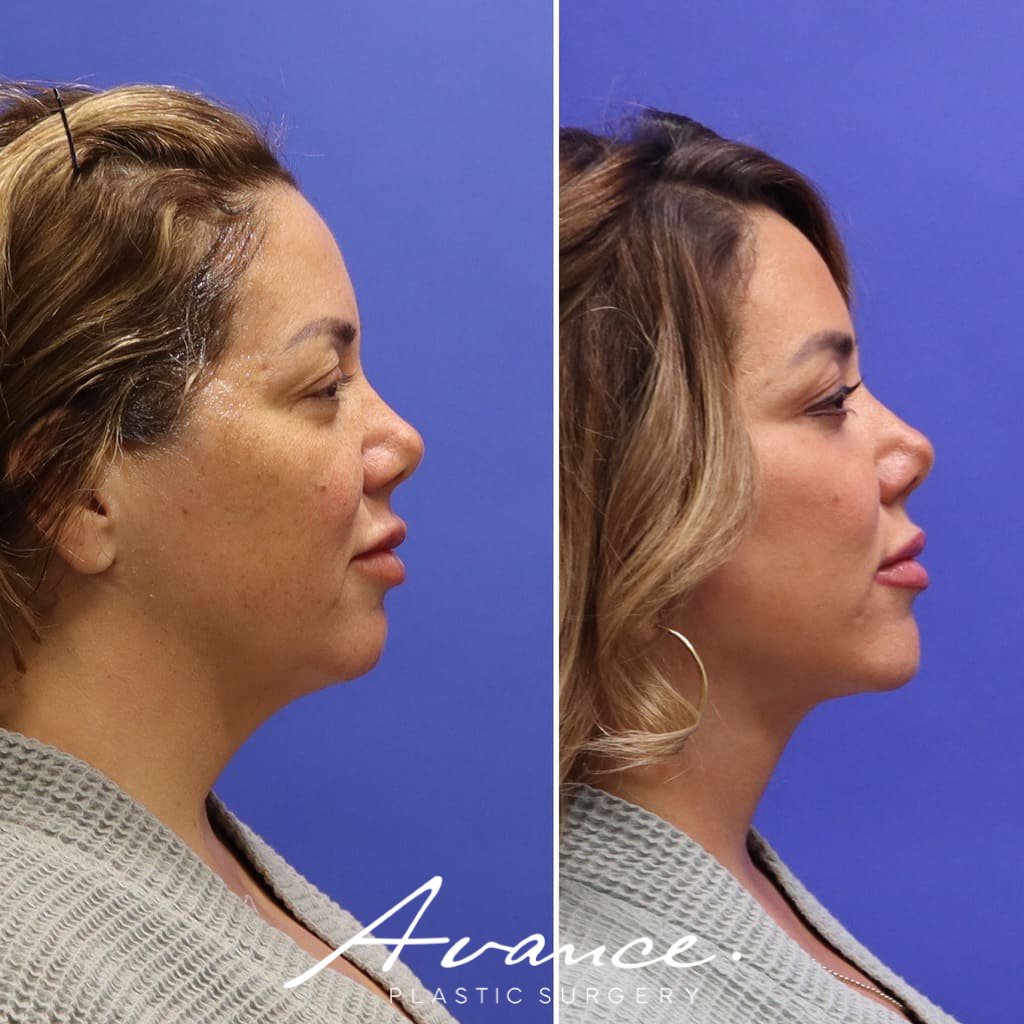 Before and After - Facelift/Necklift & Minifacelift/Necklift