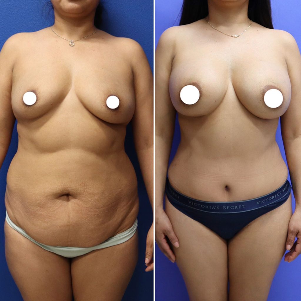 Before and After - Breast Augmentation