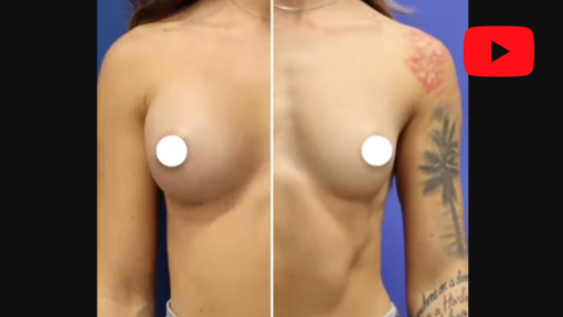YouTube video titled Breast Augmentation Before And After 