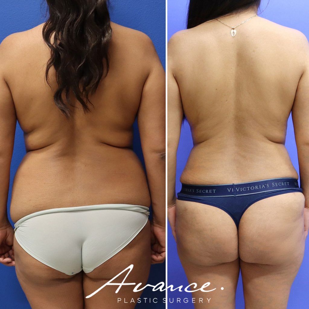 Before and After - Abdominoplasty