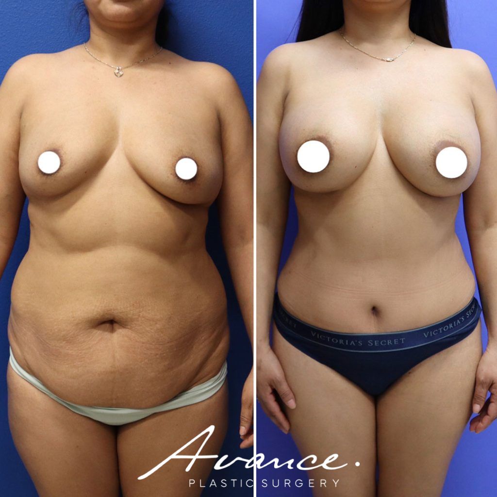 Before and After - Abdominoplasty