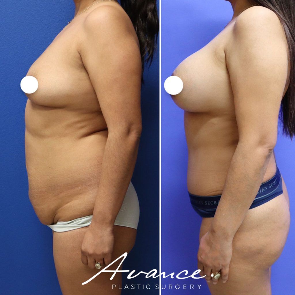 Before and After - Abdominoplasty