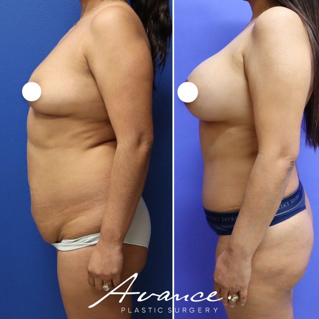 Before and After - Aumento de pecho