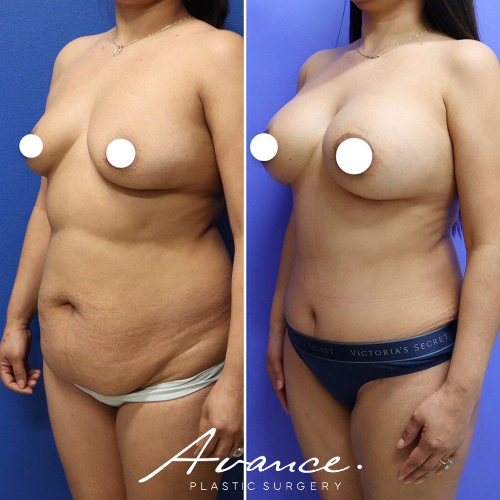 Before and After - Aumento de pecho