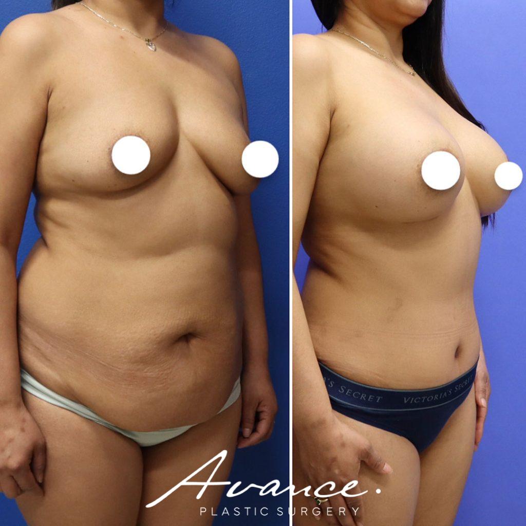 Before and After - Aumento de pecho