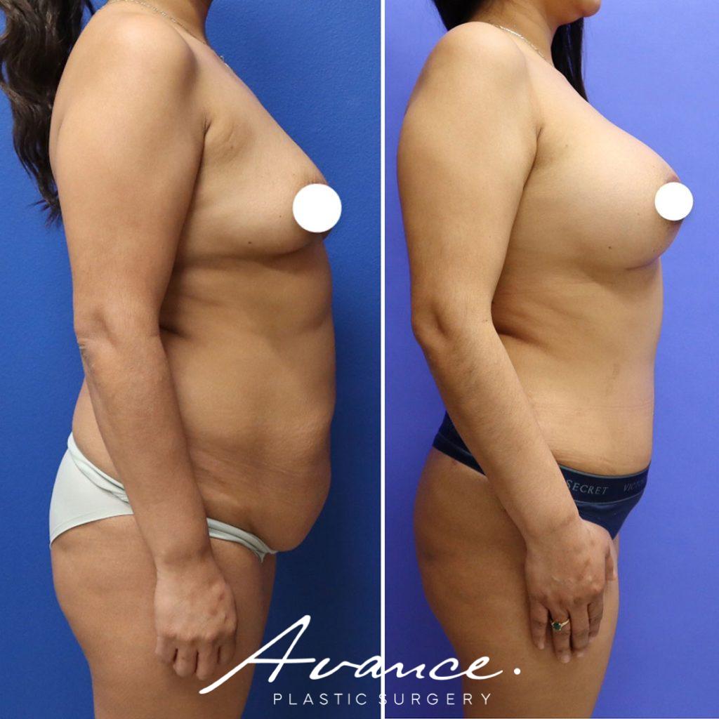 Before and After - Aumento de pecho