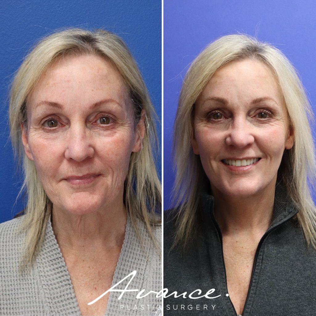 Before and After - Mini Face/Necklift