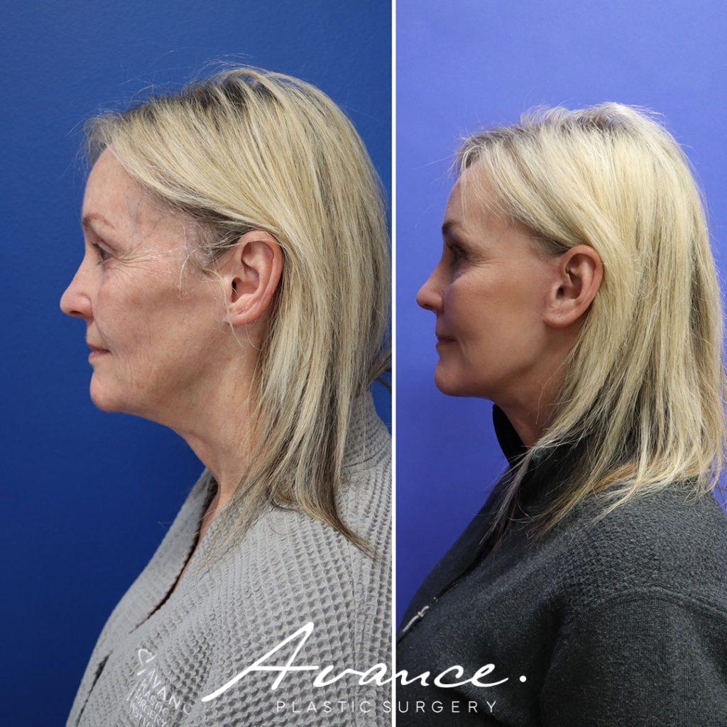 Before and After - Mini Face/Necklift