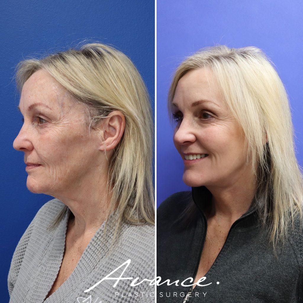 Before and After - Mini Face/Necklift