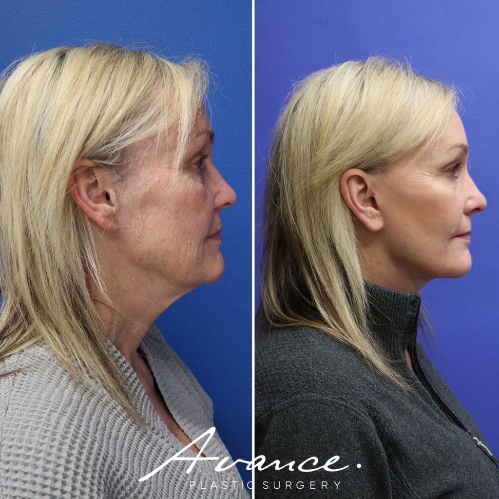 Before and After - Mini Face/Necklift