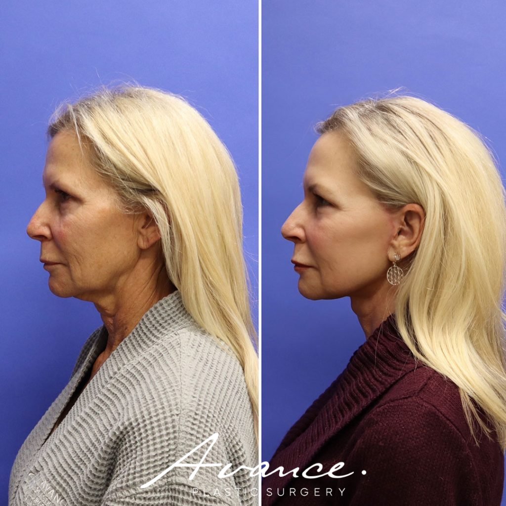 Before and After - Mini Face/Necklift