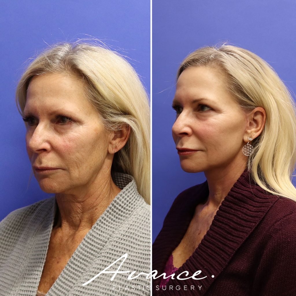 Before and After - Mini Face/Necklift