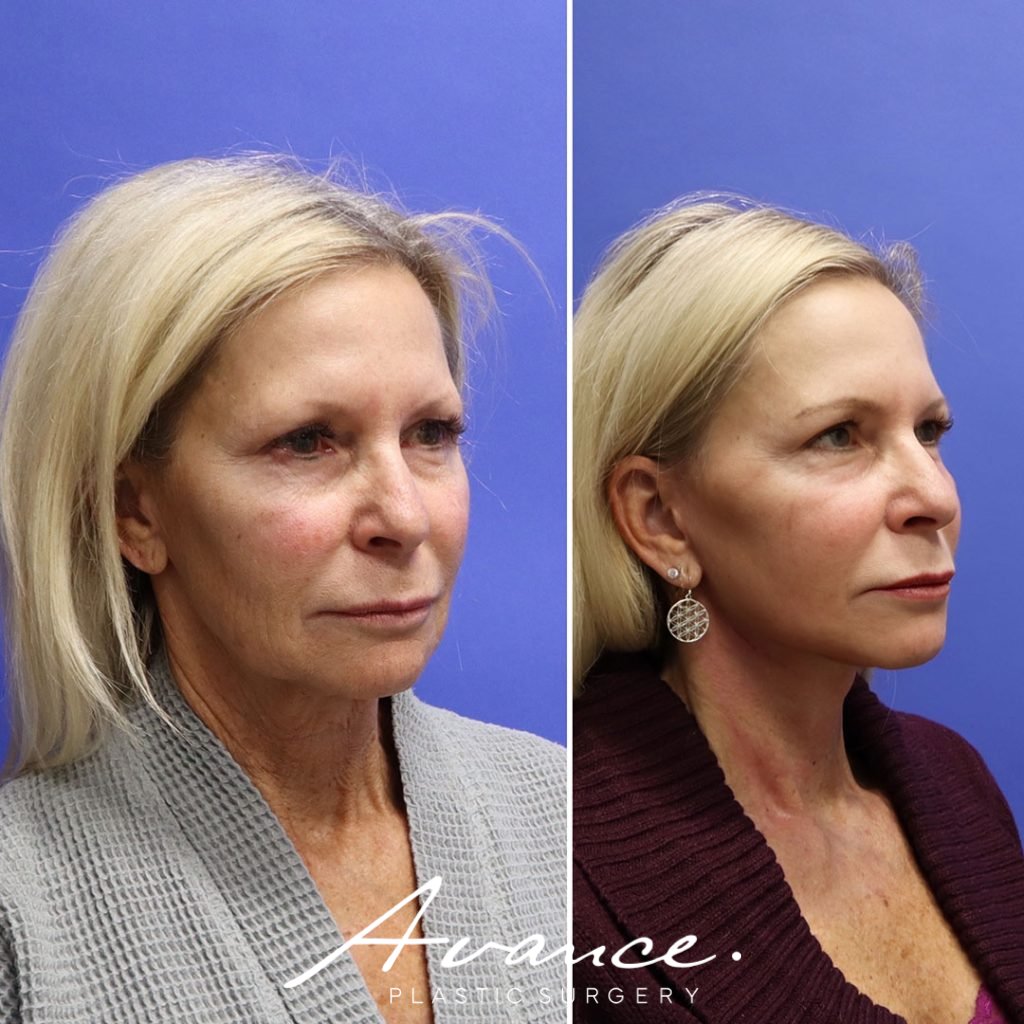 Before and After - Mini Face/Necklift