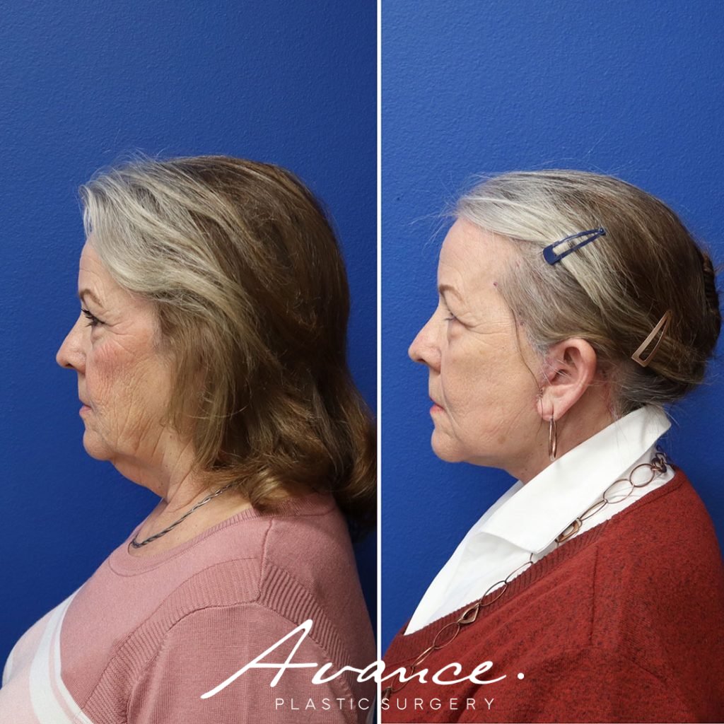 Before and After - Mini Face/Necklift