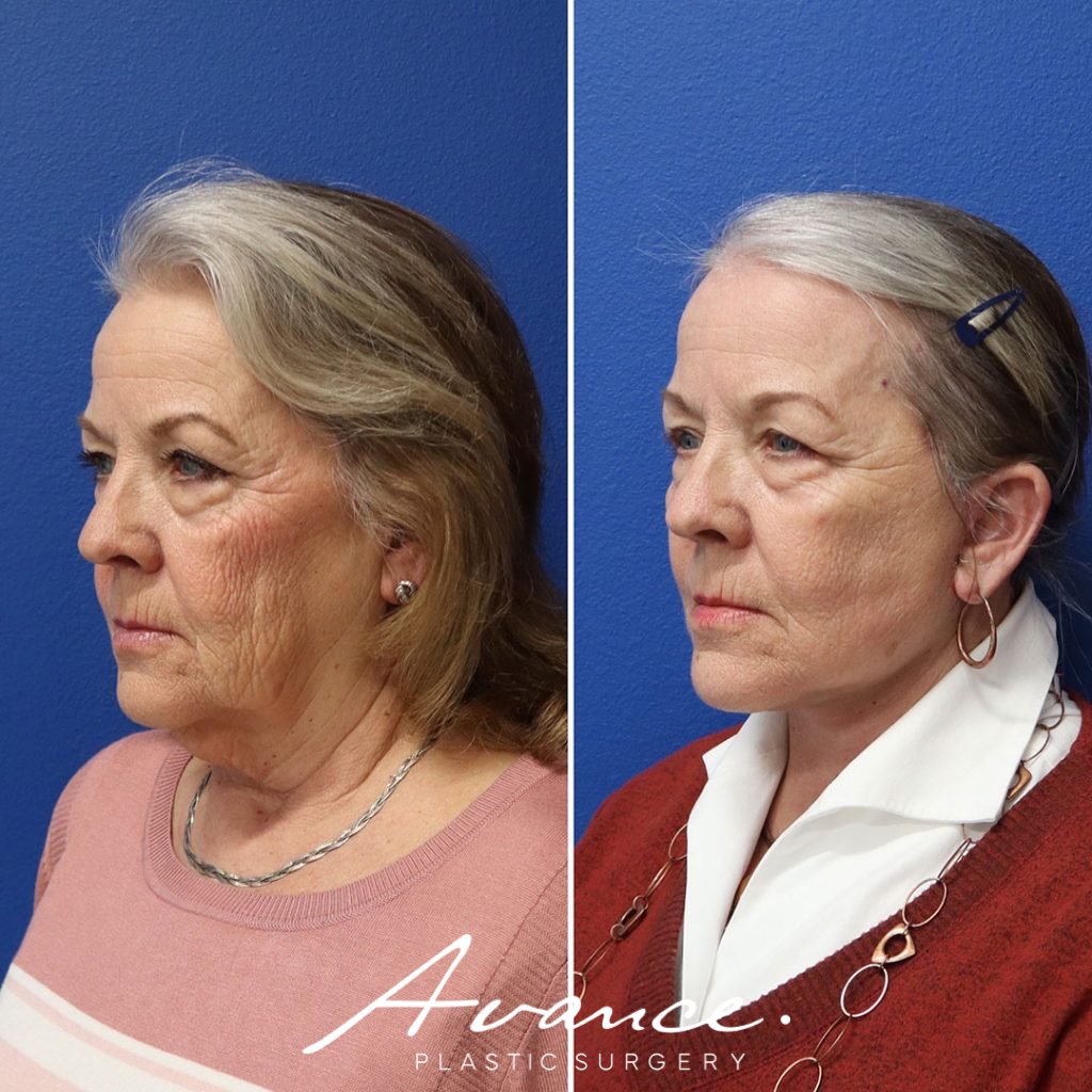 Before and After - Mini Face/Necklift