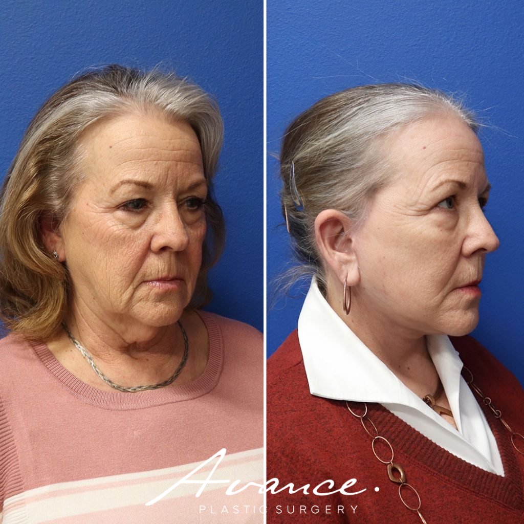 Before and After - Mini Face/Necklift