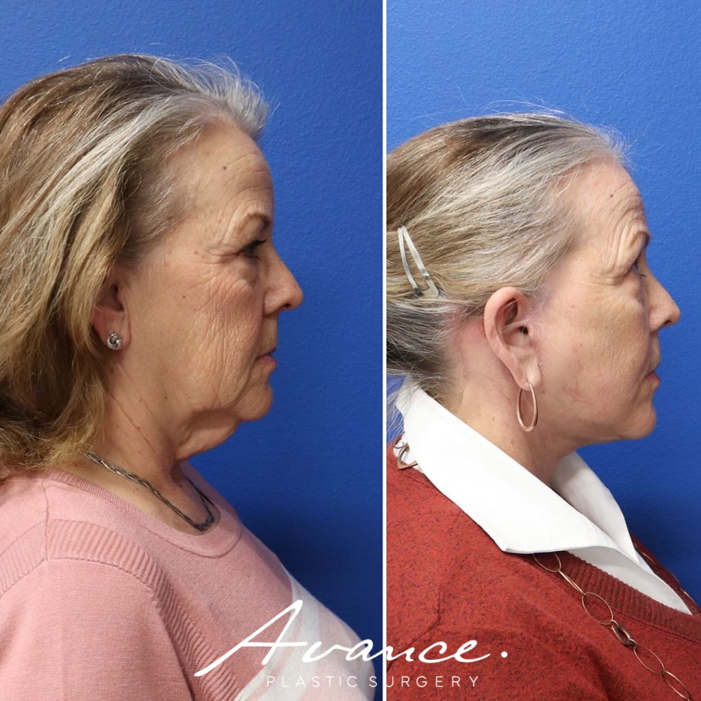 Before and After - Mini Face/Necklift