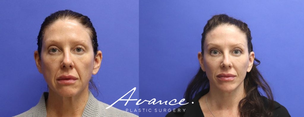 Before and After - Facelift/Necklift & Minifacelift/Necklift