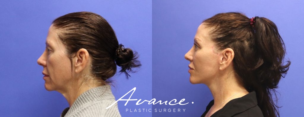 Before and After - Facelift/Necklift & Minifacelift/Necklift