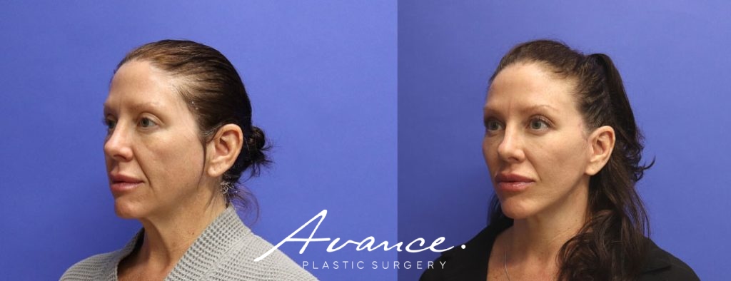 Before and After - Facelift/Necklift & Minifacelift/Necklift