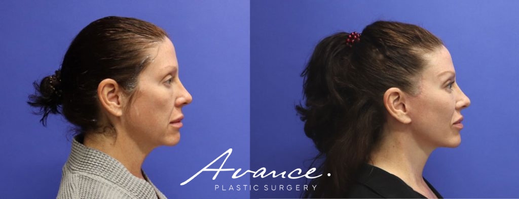 Before and After - Facelift/Necklift & Minifacelift/Necklift