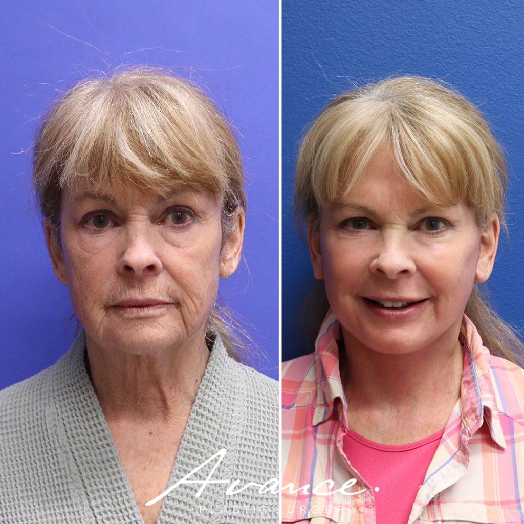 Before and After - Facelift/Necklift & Minifacelift/Necklift