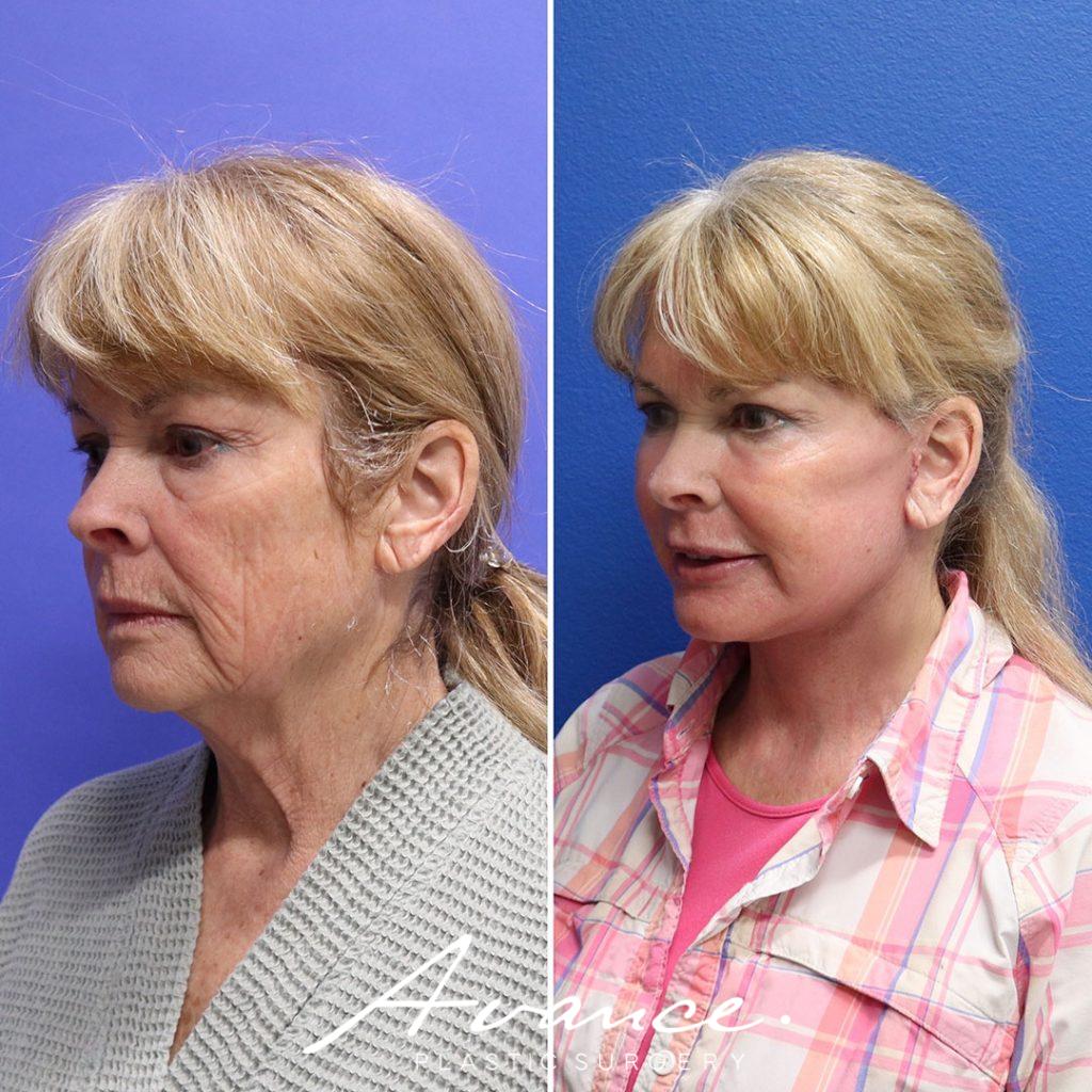 Before and After - Facelift/Necklift & Minifacelift/Necklift