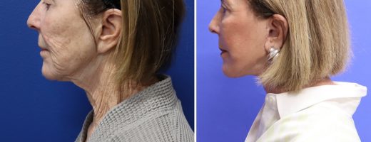 Before and After - Face & Neck