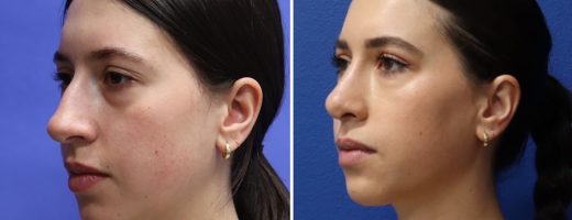 Before and After - Rhinoplasty