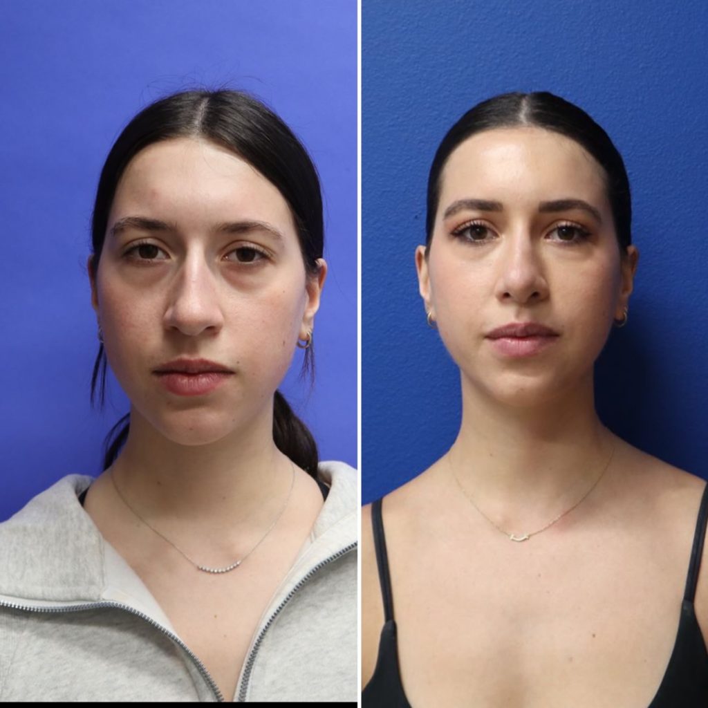 Before and After - Rhinoplasty
