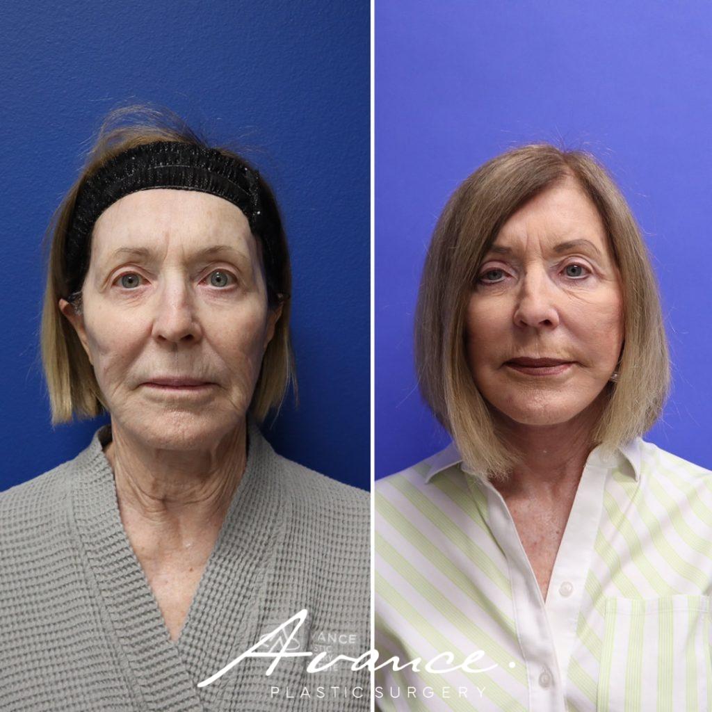Before and After - Mini Face/Necklift
