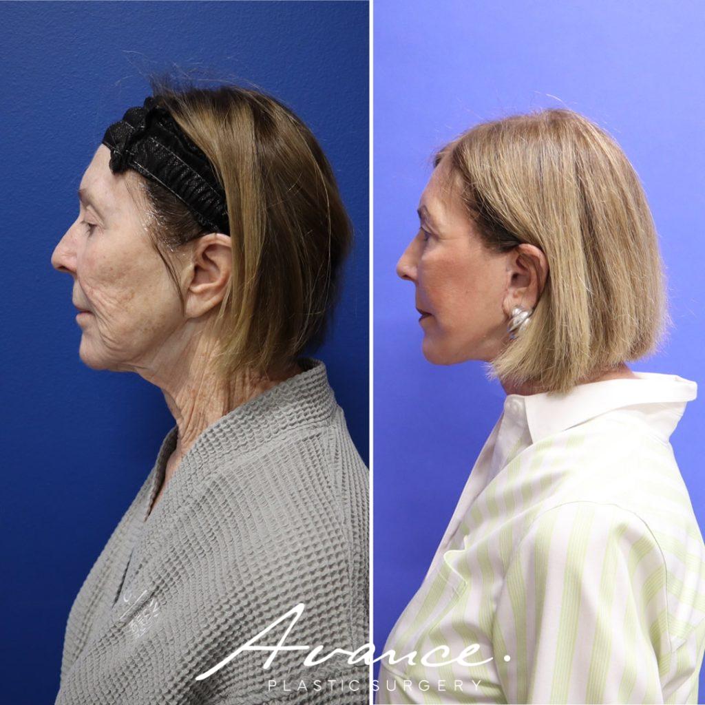 Before and After - Mini Face/Necklift