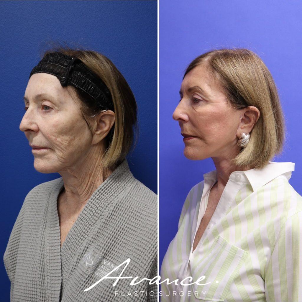 Before and After - Mini Face/Necklift