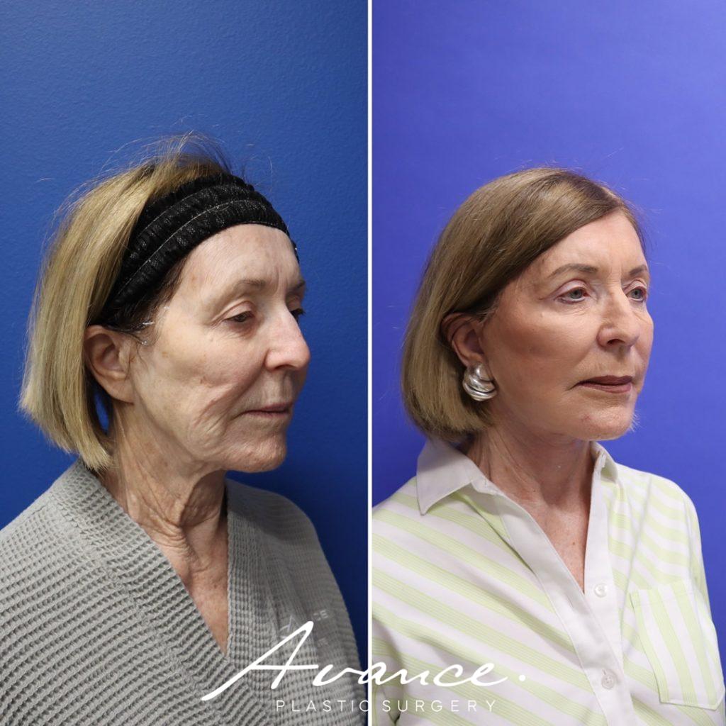 Before and After - Mini Face/Necklift