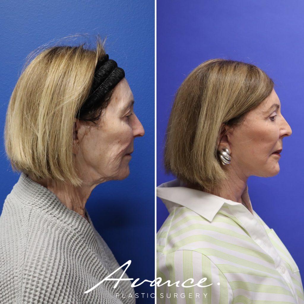 Before and After - Mini Face/Necklift