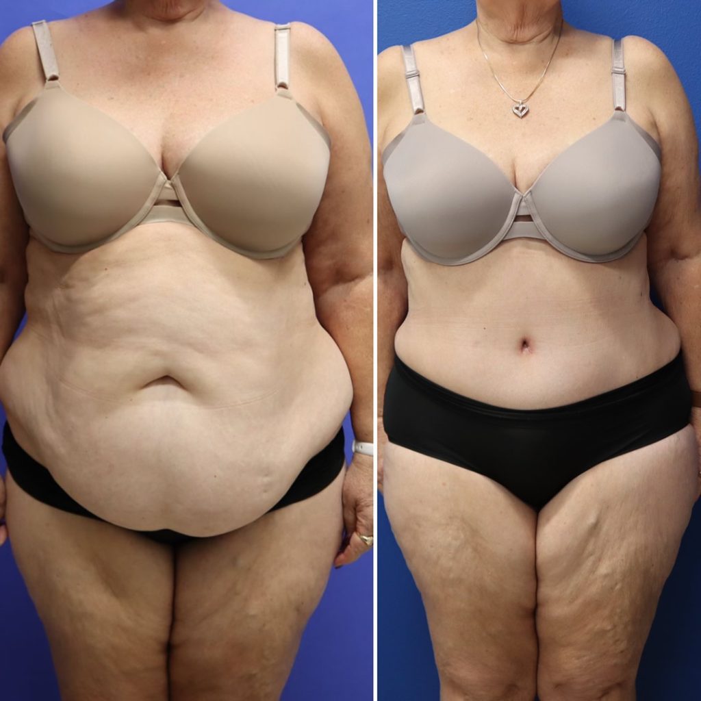 Before and After - Abdominoplasty