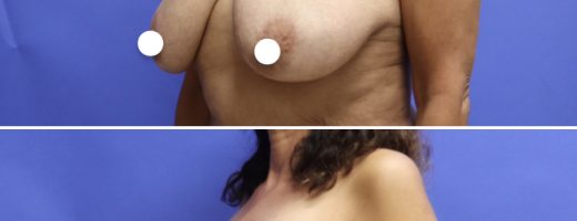 Before and After - Breast Lift